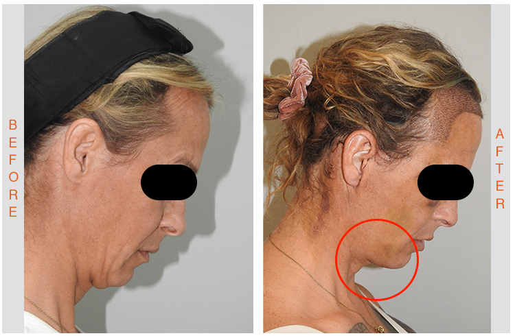 Esthetic Lyft Treatment